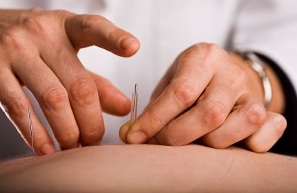 Dry Needling